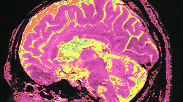 Schichtaufnahme eines menschlichen Gehirns mit Alzheimerkrankheit.