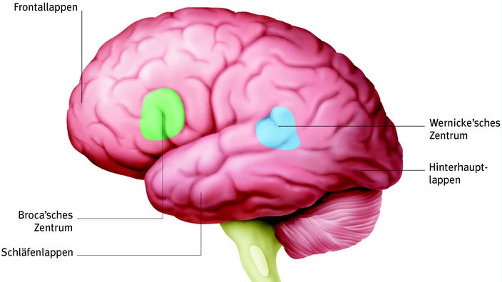 Modell eines Gehirns mit eingezeichnetem Broca- und Wernicke-Areal