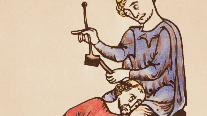 Die Zeichnung aus dem 13. Jahrhundert zeigt, wie ein Arzt einem Patienten mit Meißel und Hammer den Schädel öffnet.