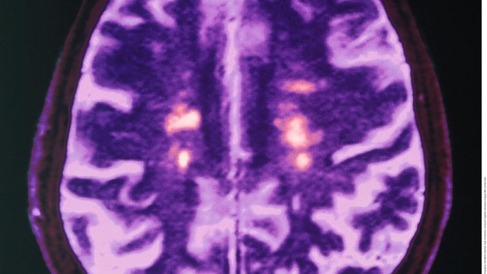 Computertomografie: das Hirn eines Menschen, der an Multiple Sklerose erkrankt ist.