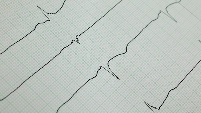 Der Audruck eines EKG-Gerätes