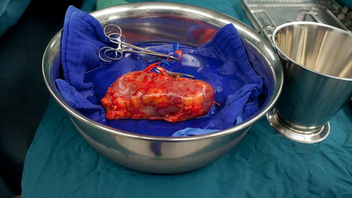 Entnommene Niere bei einer Nierentransplantation