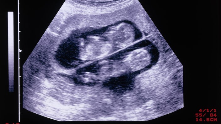 Ultraschallbild von zwei Ungeborenen.