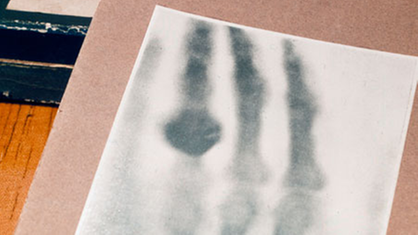 Bertha Röntgens Fingerring, für die Röntgenstrahlen undurchlässig, scheint um den Fingerknochen zu schweben.