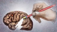 Zeichnung: Eine Hand radiert einen Teil des Gehirns aus