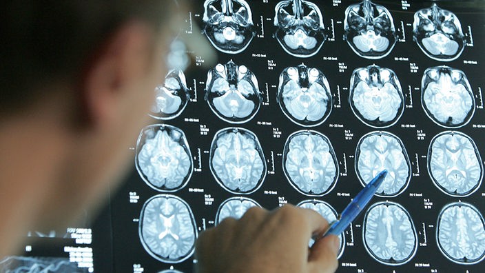 Ein Arzt zeigt mit einem Kugelschreiber auf Bilder eines Magnet-Resonanz-Tomographen (MRT), die verschiedene Gehirnquerschnitte eines Patienten zeigen