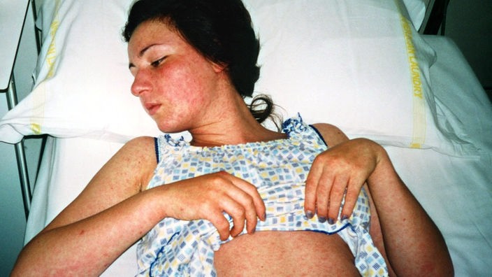 Das Bild zeigt eine Frau im Krankenbett, die ihren mit roten Flecken bedeckten Oberkörper zeigt.