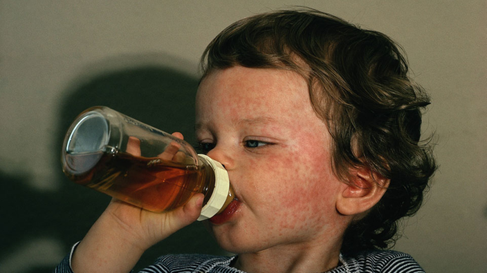 Kleiner Junge trinkt aus einem Fläschchen. Sein Gesicht ist von rotem Ausschlag bedeckt.