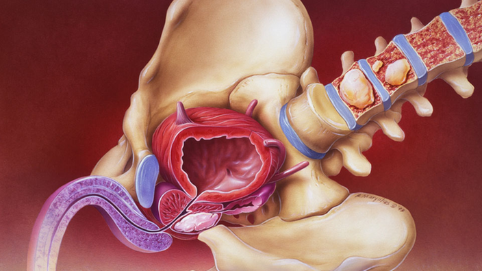 Die Grafik zeigt einen gezeichneten Beckenknochen und die Wirbelsäule. Im Becken ist ein großer Tumor zu erkennen.