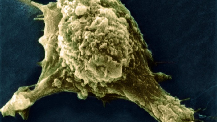 Mikroskopaufnahme einer Krebs-Metastase | Bildquelle: mauritius images / Science Photo Library Mikroskopaufnahme einer Krebs-Metastase
