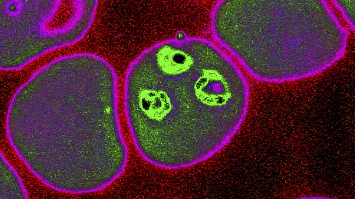 Rote Blutzellen mit dem Erreger Plasmodium falciparum unter dem Elektronenmikroskop. Die Erreger sind als lila-blaue Verfärbungen zu erkennen.