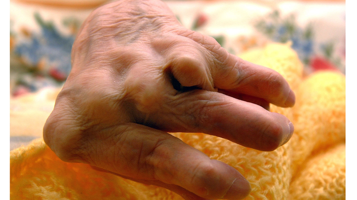 Die schwer deformierte Hand einer bettlägerigen Rheuma-Patientin