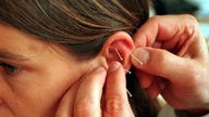 Ohrakupunktur - Nadeln werden am Ohr der Patientin gesetzt.