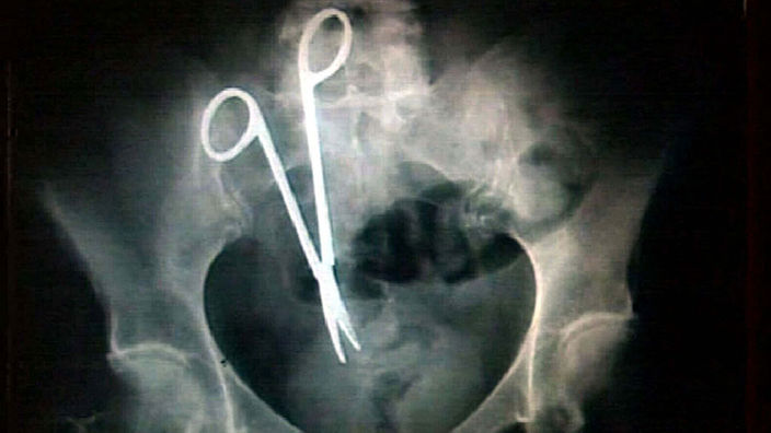 Röntgenbild mit einer OP-Schere im Bauchraum eines Patienten aus Sydney.