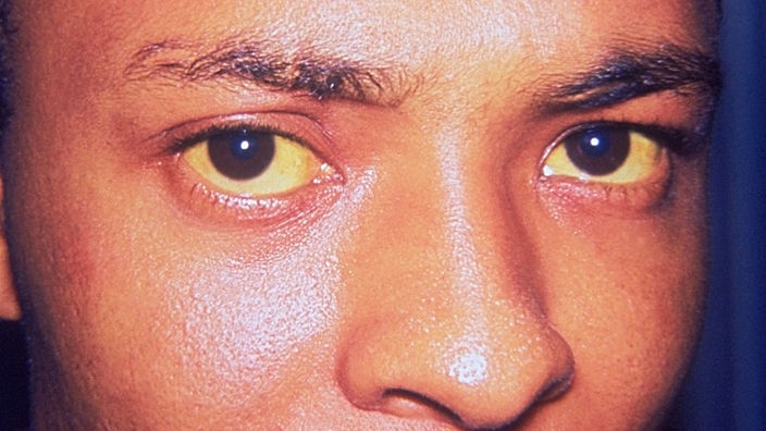 Mann mit gelben Augen  