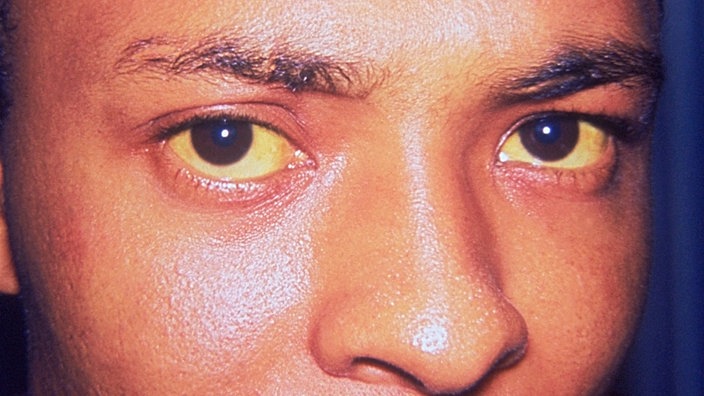 Mann mit gelben Augen | Bildquelle: Phototake / mauritius images Mann mit gelben Augen