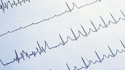 Aufzeichnung eines EKGs.