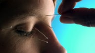 Eine Akupunkturnadel wird bei einer Patientin im Bereich des rechten Auges eingestochen.