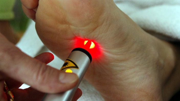 Laserakupunktur im Bereich der Fußsohle
