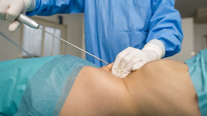 Schönheitschirurgie Fettabsaugung | Bildquelle: WDR / picture alliance / dpa Themendienst Schönheitschirurgie Fettabsaugung