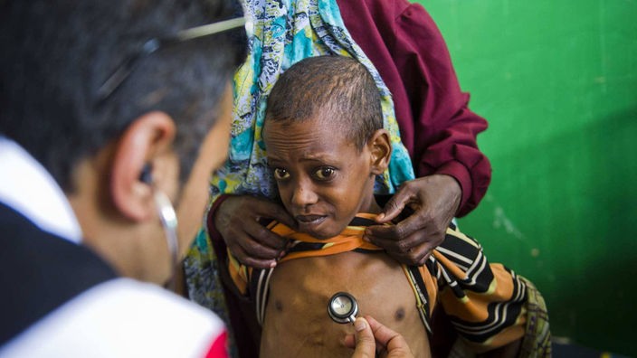 Ein unterernährtes Kind in Somalia wird von einem Arzt untersucht