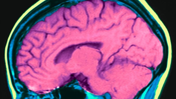Seitliche Aufnahme eines menschlichen Gehirns aus dem Kernspintomographen.