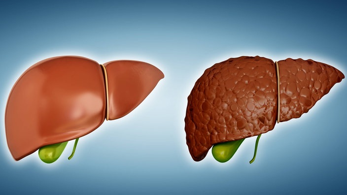 Vergleich einer gesunden Leber (links) und einer Leberzirrhose (rechts) | Bildquelle: Imago/Science Photo Library Vergleich einer gesunden Leber (links) und einer Leberzirrhose (rechts)