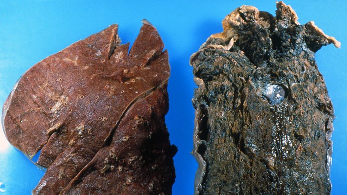 Zwei präparierte Lungen liegen nebeneinander. Die rechte Lunge ist durch das Rauchen sichtbar geschwärzt und angegriffen
