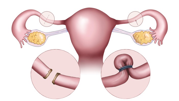 Kosten sterilisation bei frauen Verhütung: Sterilisation