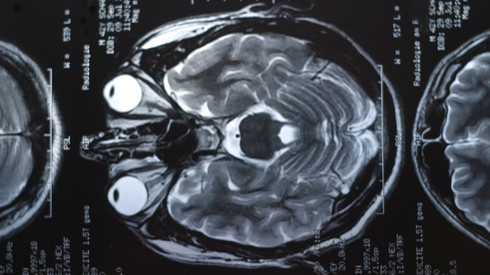 schwarz-weiß Bild eines Gehirns.