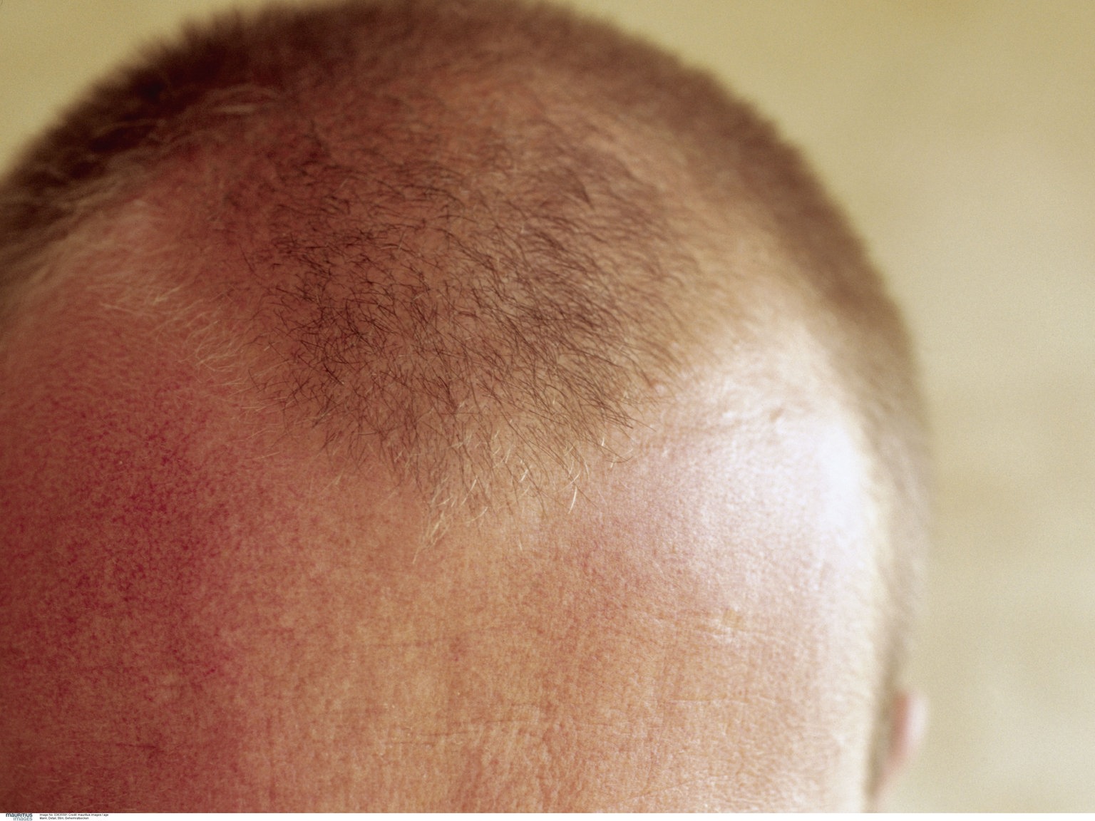 Was tun geheimratsecken Frisuren Frauen