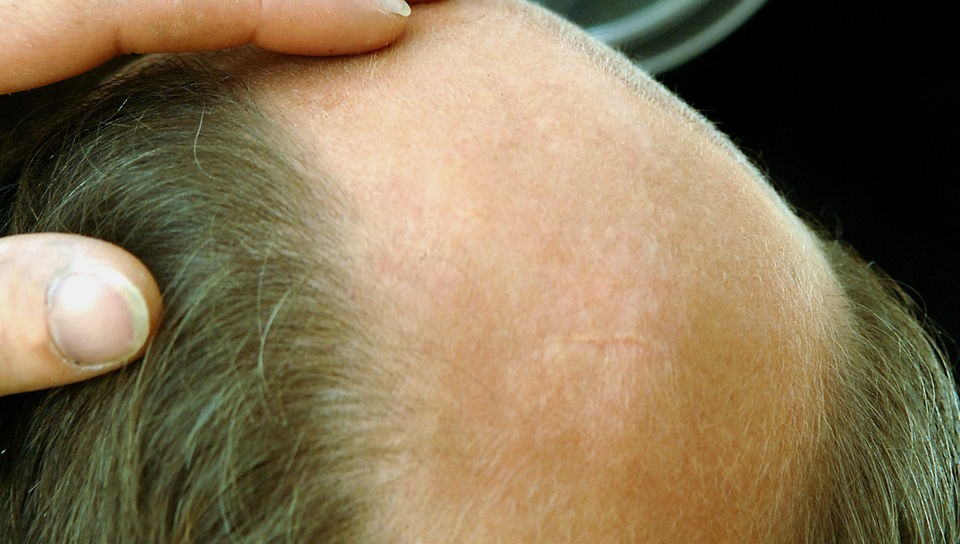 Großaufnahme auf den Kopf eines Mannes mit akutem Haarausfall