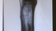 Röntgenbild eines großen Röhrenknochen, auf dem feine Querlinien zu erkennen sind