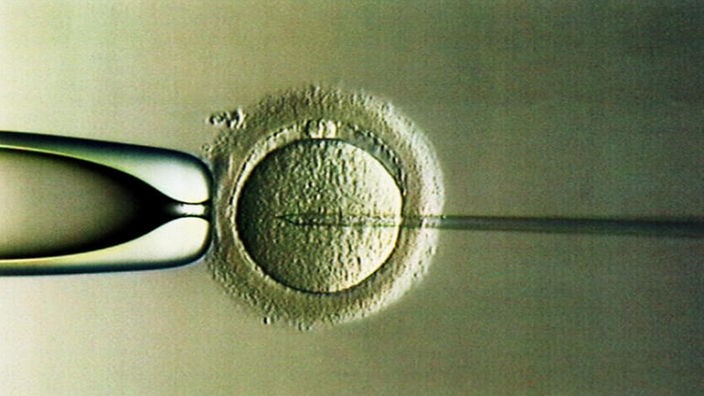 Intra-Cytoplasmatische Sperma-Injektion (ICSI), bei der die Spermien des Mannes im Labor direkt in eine der Frau entnommenen Eizelle injiziert werden.