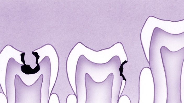 Die Zeichnung zeigt drei Zähne, die an unterschiedlichen Stellen von Karies befallen sind.