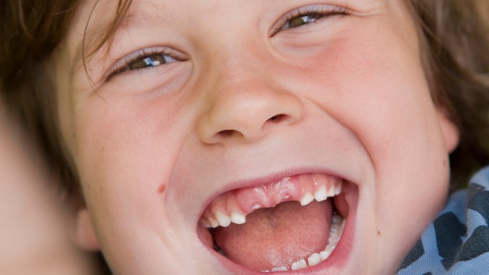 Ein Kind mit Zahnlücken