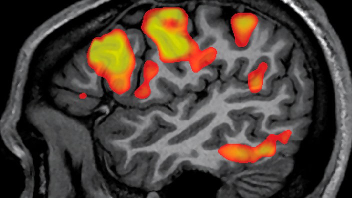 Die Kernspintomographie eines menschlichen Gehirns zeigt die aktiven Hirnbereiche beim Sprechen.