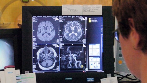 Querschnitt-Ansichten eines menschlichen Gehirns auf einem Computermonitor