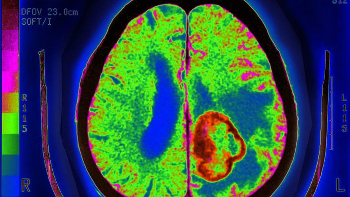 Querschnitt-Aufnahme eines Gehirns mit einem Tumor und Metastasen.