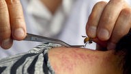 Ein chinesischer Arzt behandelt einen Patienten mit einer Biene, die ihn in den Nacken sticht.