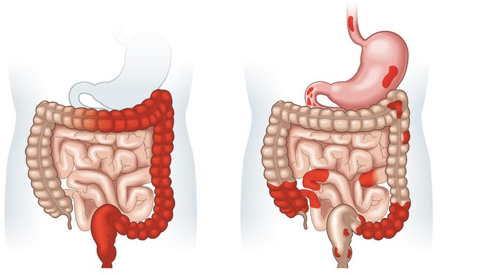 Grafik der Darmerkrankungen Colitus ulcerose und Morbus Crohn.