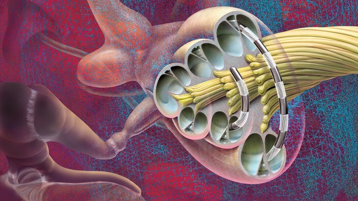 Illustration des eingesetzten Cochlea-Implantats in die Hörschnecke.