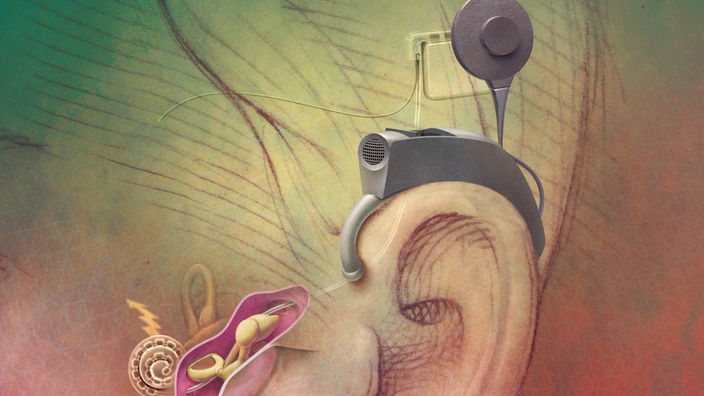 Illustration des eingesetzten Cochlea-Implantats am Ohr.