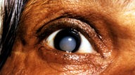 Nahaufnahme eines Auges mit Grauem Star: Die Augenlinse hat sich getrübt