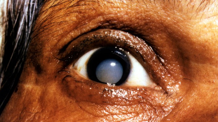 Nahaufnahme eines Auges mit Grauem Star: Die Augenlinse hat sich getrübt