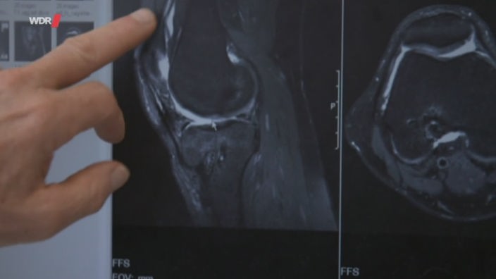 Ein Finger zeigt auf eine Röntgenaufnahme des Knies