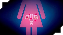 Menstruation und Endometriose