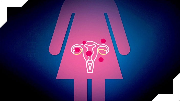 Menstruation und Endometriose