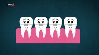 Grafik von vier lächelnden Zähnen, die mit einem Draht verbunden sind