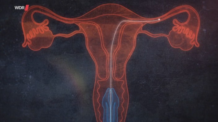 Computergrafik: Der Weg eines Spermiums durch Gebärmutter und Eileiter